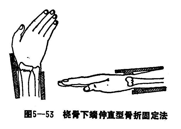 十四 桡骨下端骨折 光明中医教材