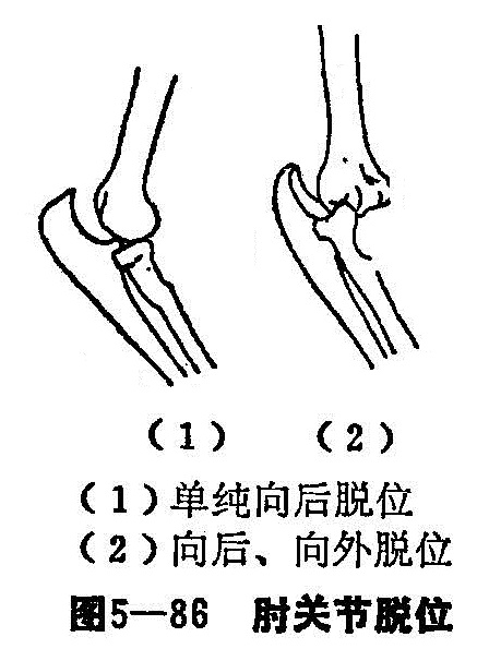 骨头脱臼原理示意图图片